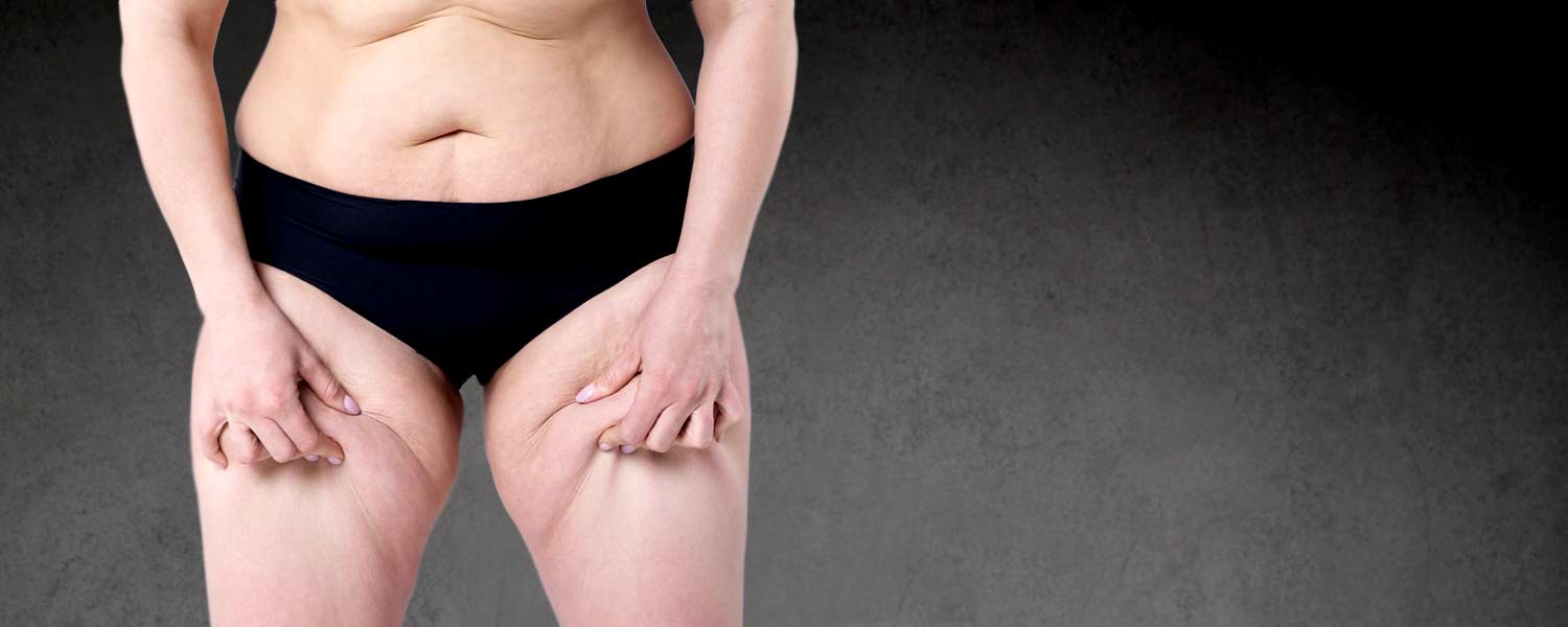 Cryolipolyse des Cuisses Lille