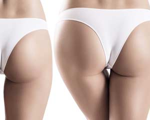Lifting des fesses