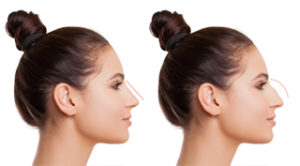 Rhinoplastie clinique Clemenceau Lille