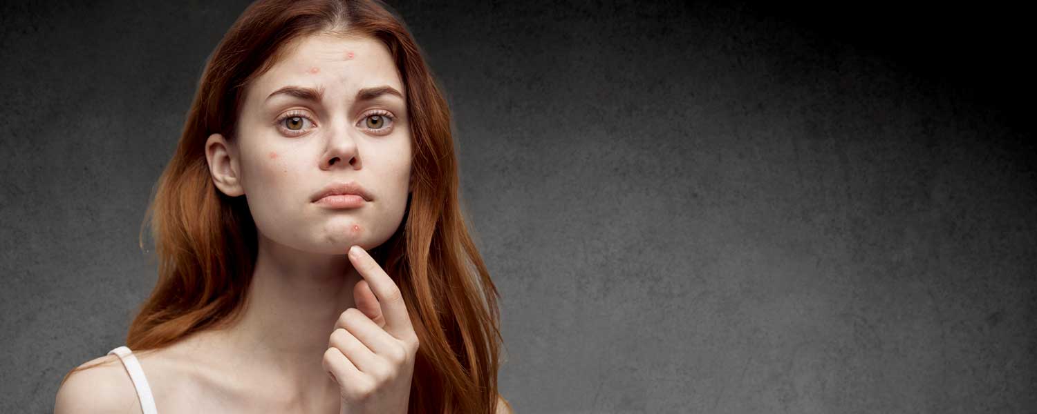 Traitements de l'Acné chez l'adulte