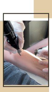 Détatouage Laser à Lille et arras - Clinique Clémenceau