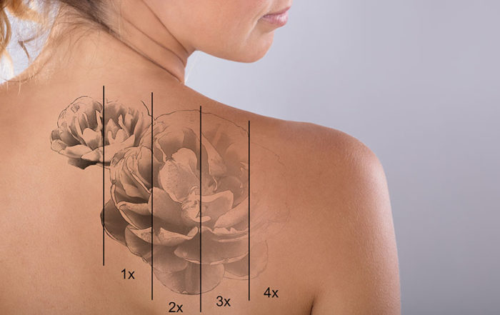 Retrait tatouage laser à Lille et arras - Clinique Clemenceau