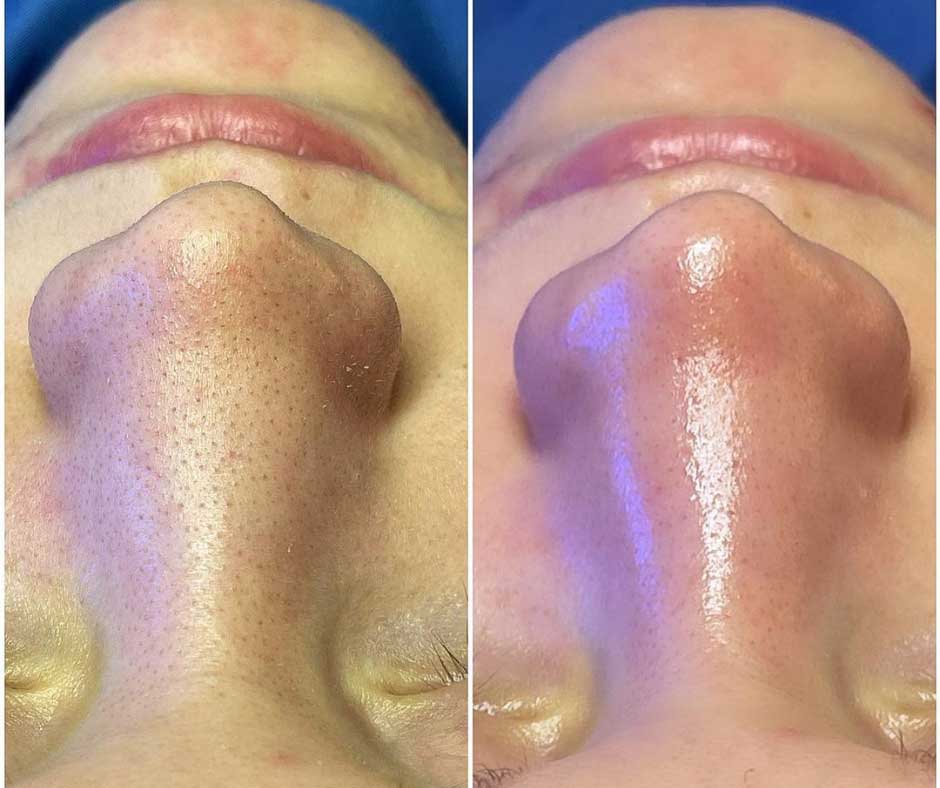 Avant / après hydrafacial à Lille