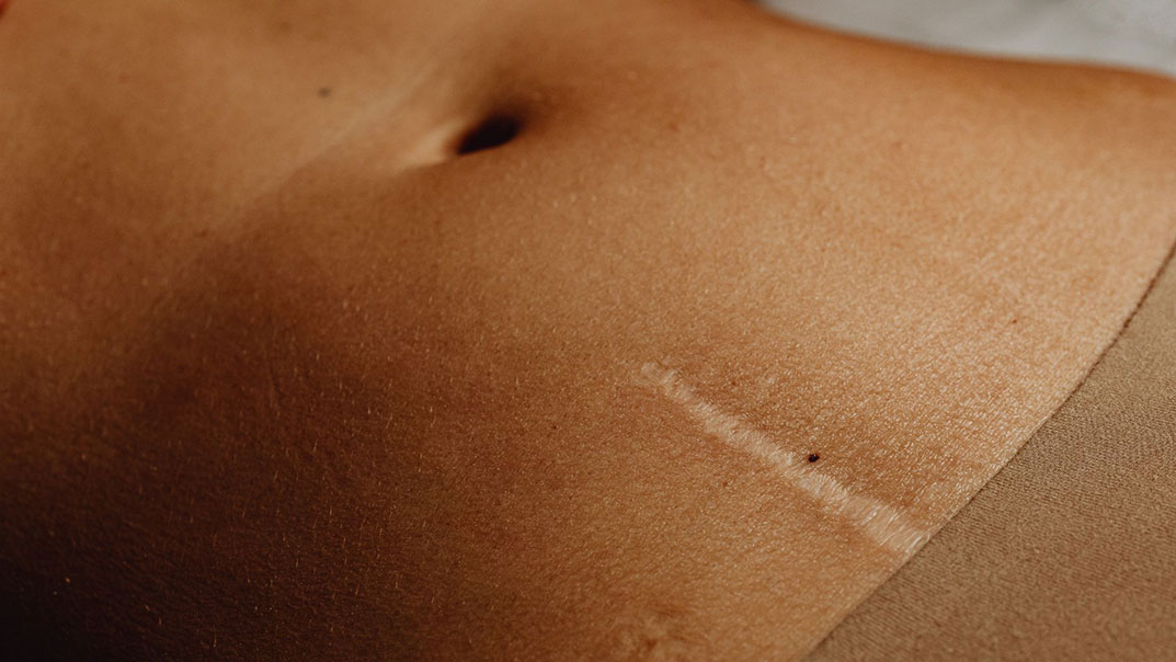 La cicatrice après une chirurgie esthétique : comment bien l’appréhender et en prendre soin ?