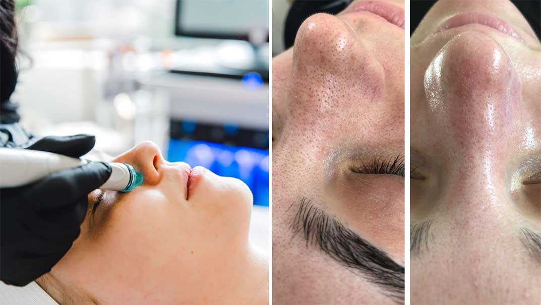 Soin Hydrafacial à la Clinique Clemenceau à lille