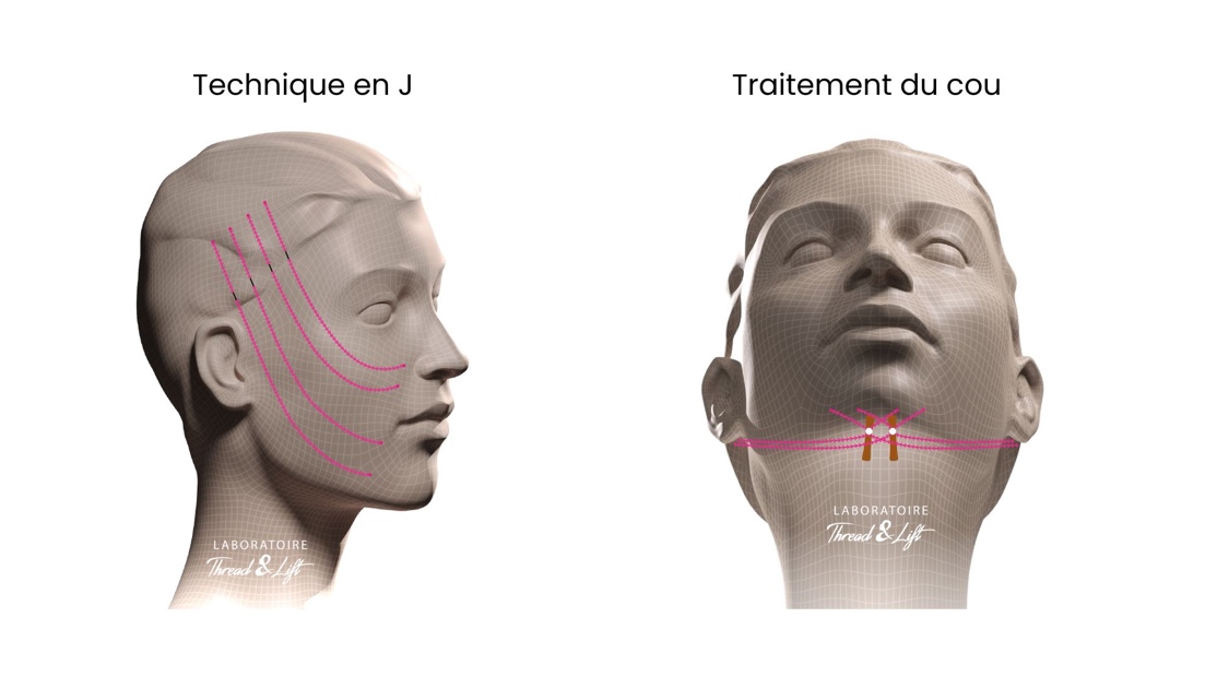 Techniques des Fils tenseurs permanents à Lille à la Clinique Clemenceau