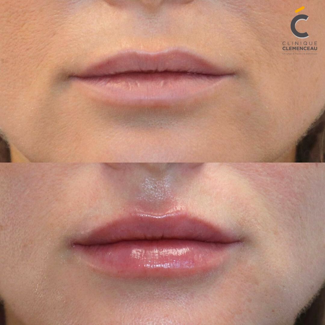 Résultat des injections à l'acide hyaluronique pour les lèvres