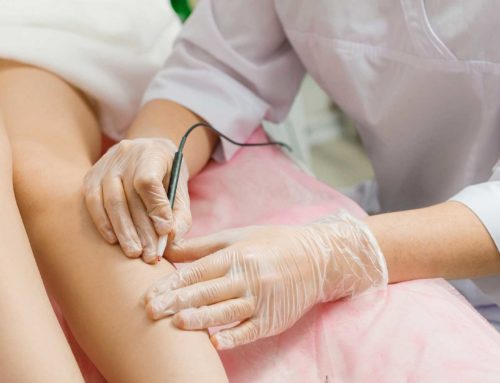L’avantage de l’épilation électrique à la Clinique Clemenceau à Lille : efficacité, précision et satisfaction des patients