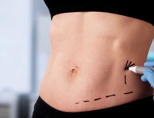 La lipoaspiration ne fait pas maigrir, mais elle peut transformer une silhouette !