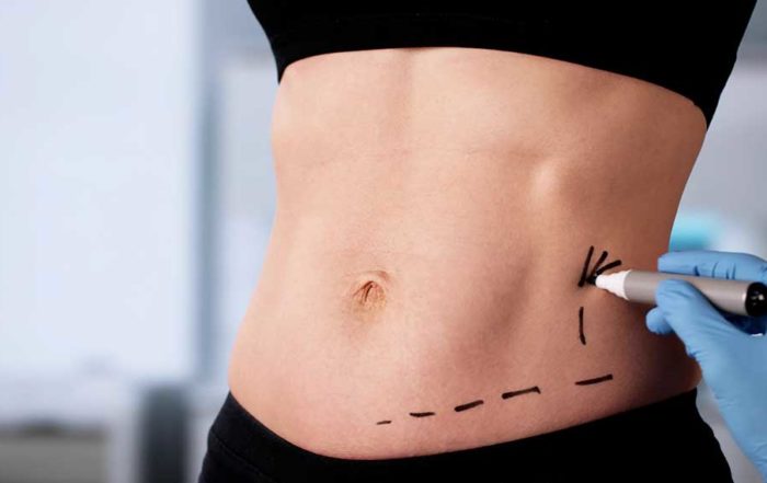 Liposuccion à Lille