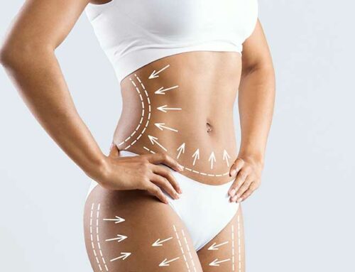 Abdominoplastie ou liposuccion : pourquoi ces deux interventions ne répondent pas au même problème ?