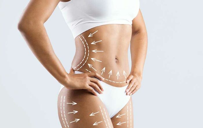 Abdominoplastie ou liposuccion ?