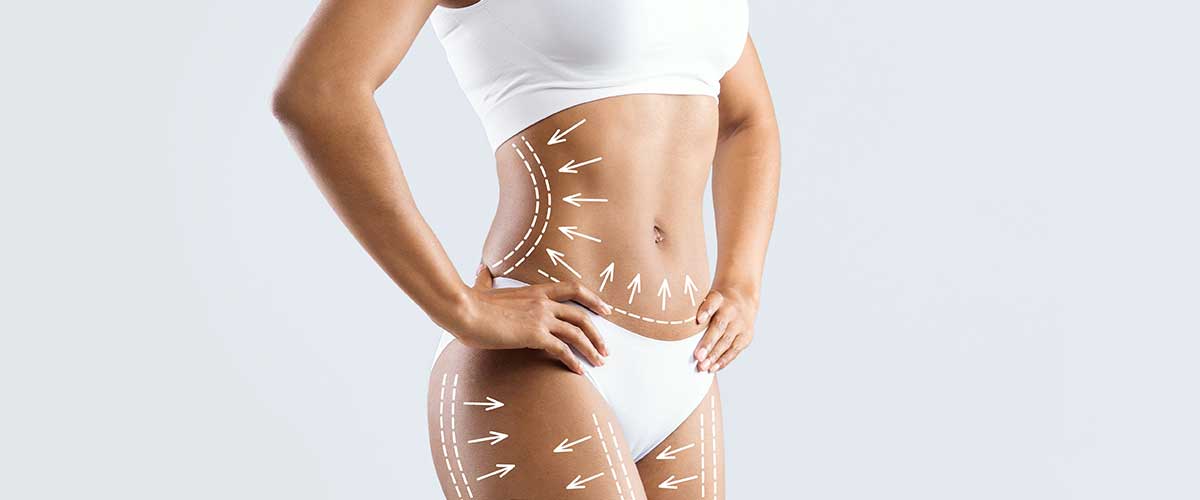 Abdominoplastie ou liposuccion ?